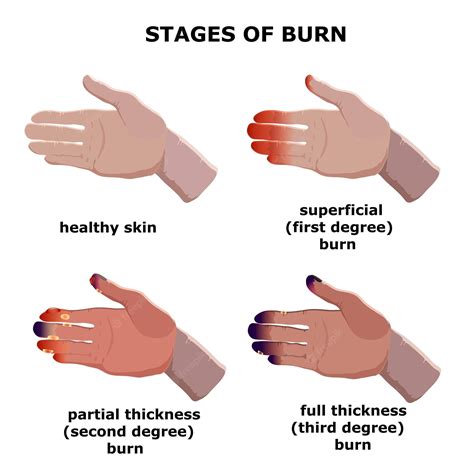 Search results for 'burn' .